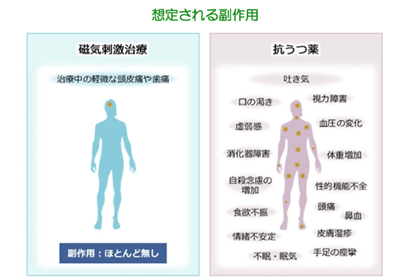 薬を使わないうつ病治療法とは？TMS療法のメリットなどを紹介】 - 医療